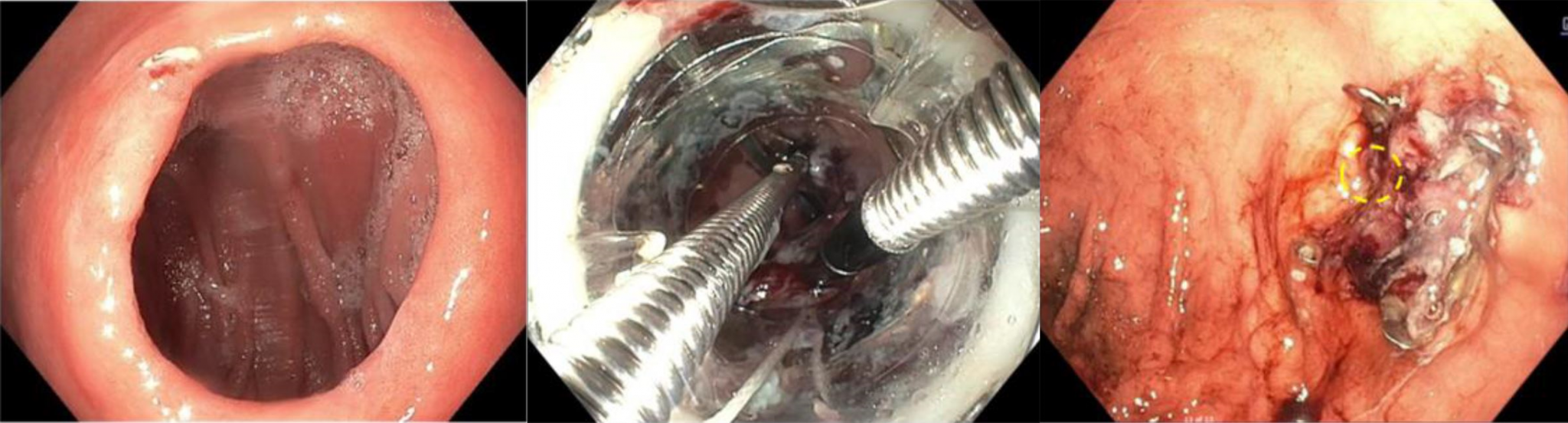 Endoscopic view