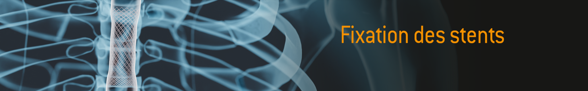 News_Banner_Stentfixierung-FR_2560x400px